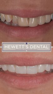 News 5 Porcelain dental veneers showing a before and after smile transformation at Hewett's Dental, professionals in Brighouse, Huddersfield, Halifax, and Bradford.