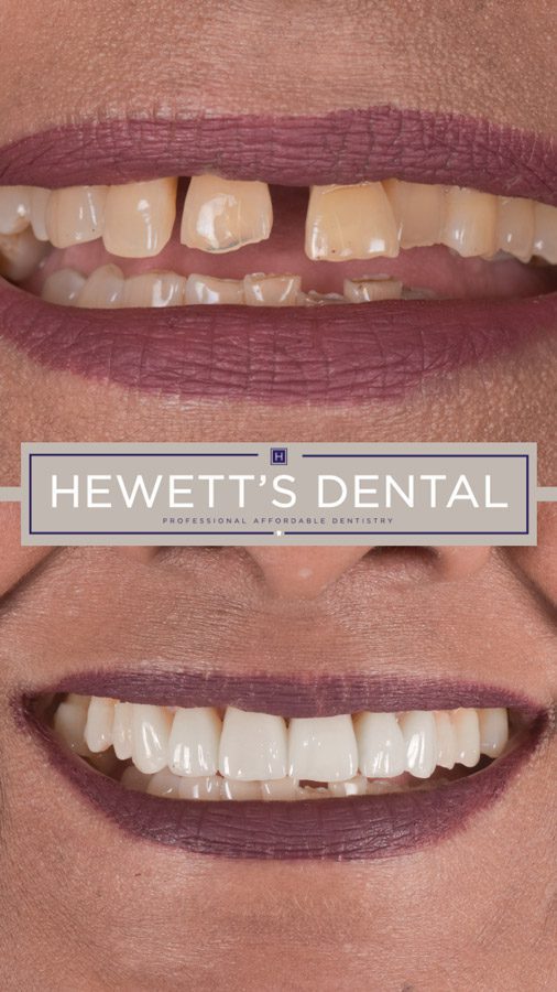 Ceramic dental veneers before and after treatment, showcasing a significant smile transformation at Hewett's Dental, serving Brighouse, Huddersfield, Halifax, and Bradford.