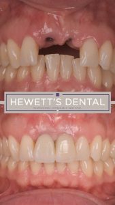 News 4 Missing teeth and dental repair, showing before and after images of dental treatment at Hewett's Dental, Brighouse, Huddersfield, Halifax, Bradford.